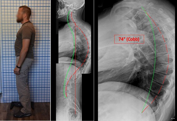 The Management Of An Adult Male With Hyper Kyphosis Cottonwood Chiropractic Midvale UT