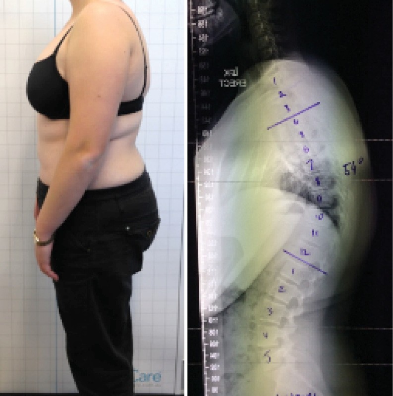 Scoliosis After Photo